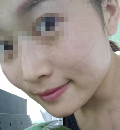 南寧東方整形祛斑案例效果對(duì)比3