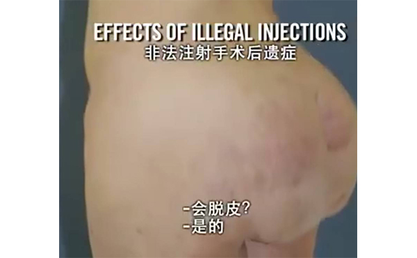 自體脂肪豐臀會留疤嗎?術后皮膚不平整怎么辦?