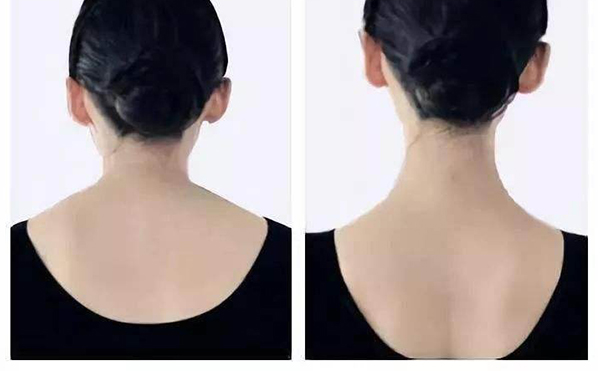 瘦肩針是用什么打的?