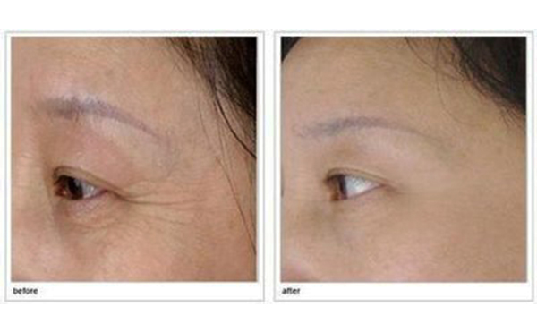 玻尿酸去魚尾紋多久注射一次？