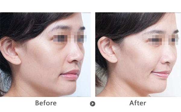 玻尿酸去法令紋多少錢？