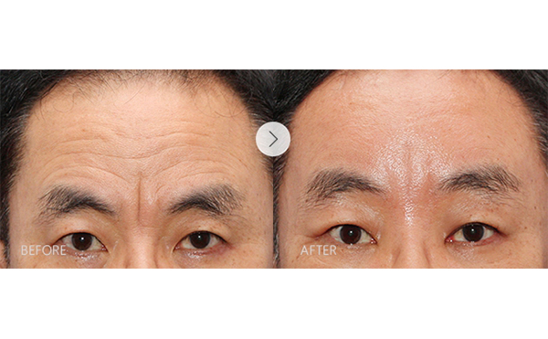 玻尿酸去抬頭紋安全嗎？