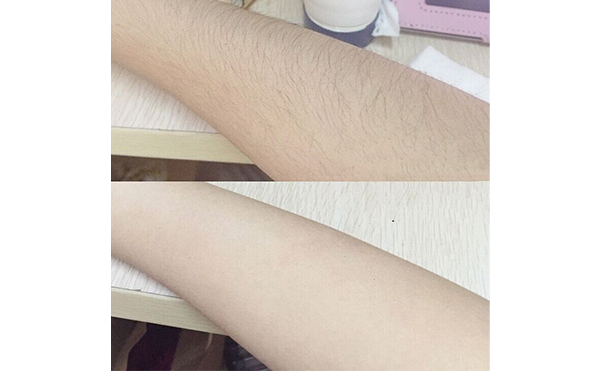 光子手臂脫毛效果怎么樣？