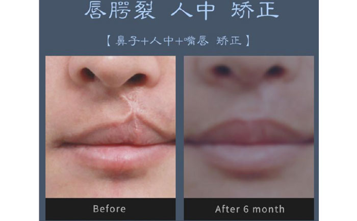 唇裂修復(fù)術(shù)需要多少錢？