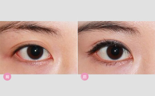 眼瞼外翻矯正方法有哪些?眼瞼外翻術后有什么常見問題?