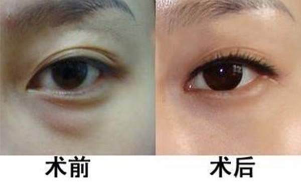 眼袋抽脂適合哪些人？