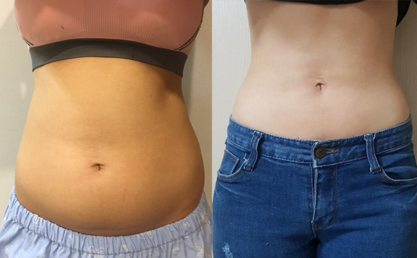 腰腹吸脂的效果好嗎？