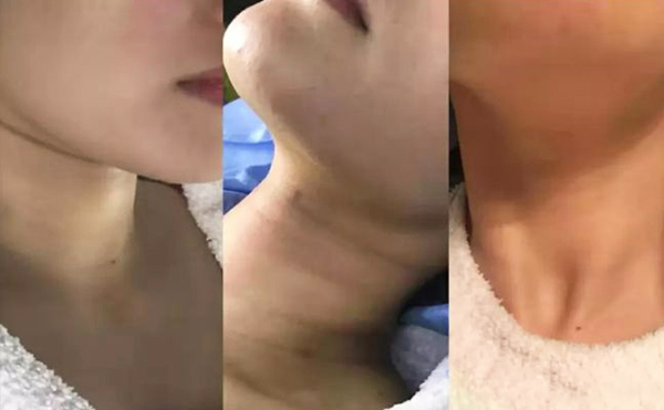 激光去頸紋多少錢？