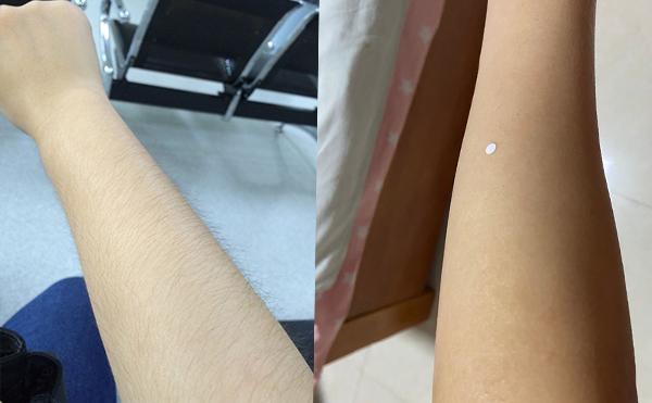 激光手臂脫毛