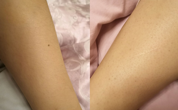 冰點(diǎn)脫腿毛幾次有效?有什么優(yōu)勢?