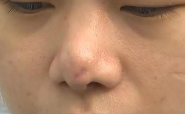 如果更換隆鼻假體，當(dāng)天可以直接換嗎?