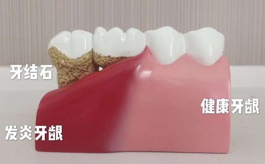 洗完牙后牙齒會(huì)變得敏感？