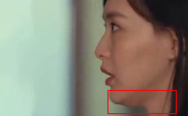 面部輪廓整形后是否會(huì)出現(xiàn)皮膚松弛下垂取決于哪些方面?