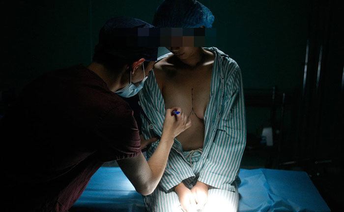 目前哪種隆胸最安全？假體隆胸哪種植入方法最好？