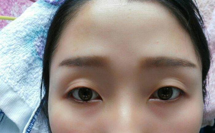 眼瞼凹陷怎么回事？眼瞼凹陷用什么填充最合適？