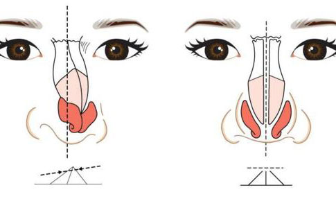 歪鼻矯正手術(shù)大概多少錢？歪鼻矯正手術(shù)成功率為多少？