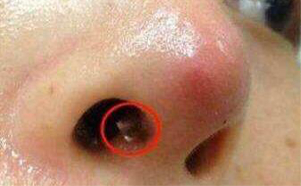 蕪湖伊萊美隆鼻失敗修復(fù)需要費(fèi)用嗎?