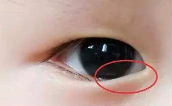小孩倒睫毛有什么癥狀?小孩倒睫怎么辦?