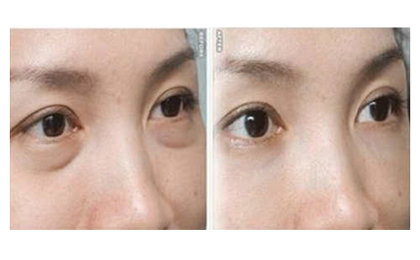 吸脂去眼袋有什么優(yōu)勢(shì)？
