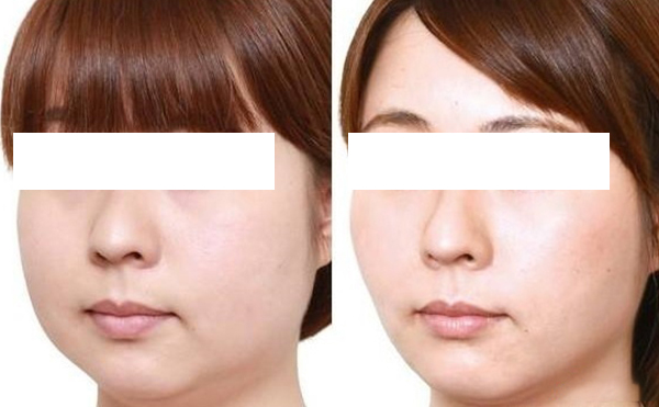 面部吸脂術(shù)適合哪些人群？