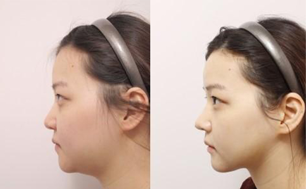 五類建議做下巴整形的下巴，快看看有沒有你