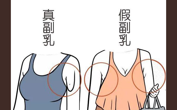 多乳癥是什么癥狀？