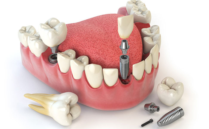 植牙多少錢一顆，植牙的種植體哪種好？