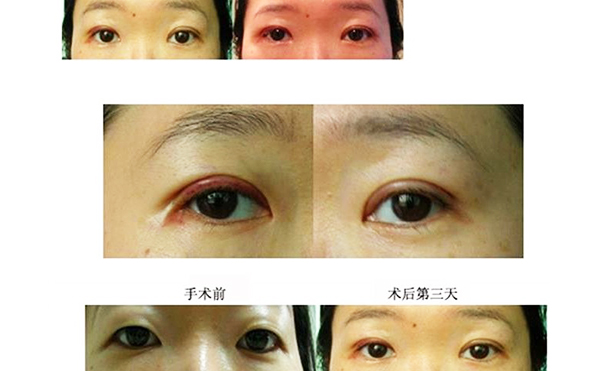 開外眼角和眼瞼下至的區(qū)別是什么?多久恢復好?