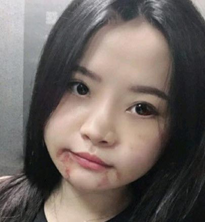 吳興中下頜角磨骨案例