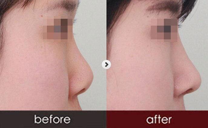 硅膠隆鼻一般需要多少錢(qián)呢？