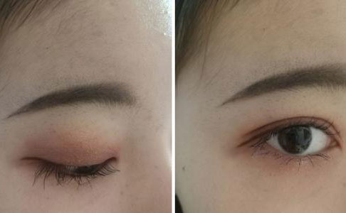 割雙眼皮的危害是什么？