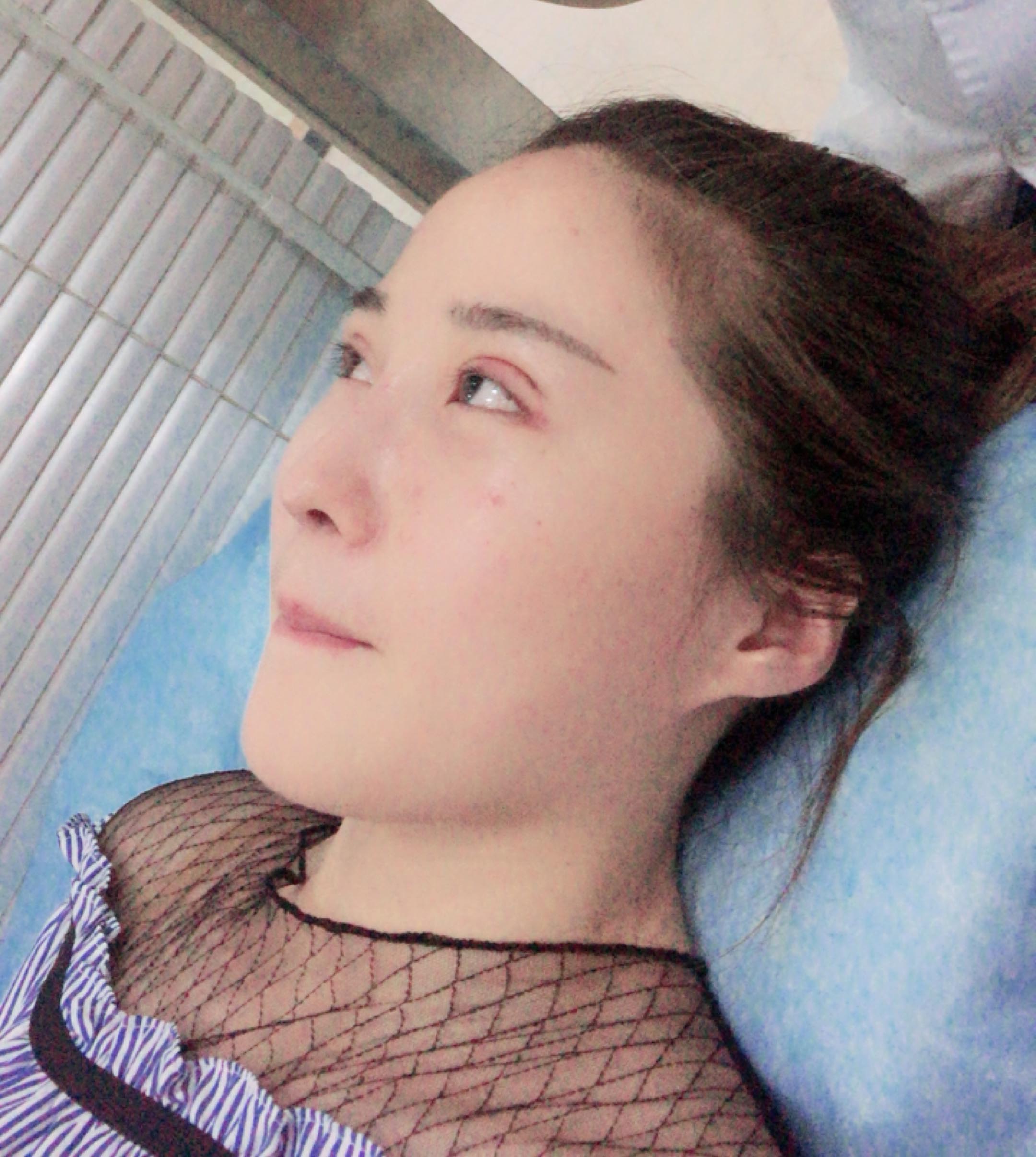 雙眼皮修復(fù)效果對比圖2