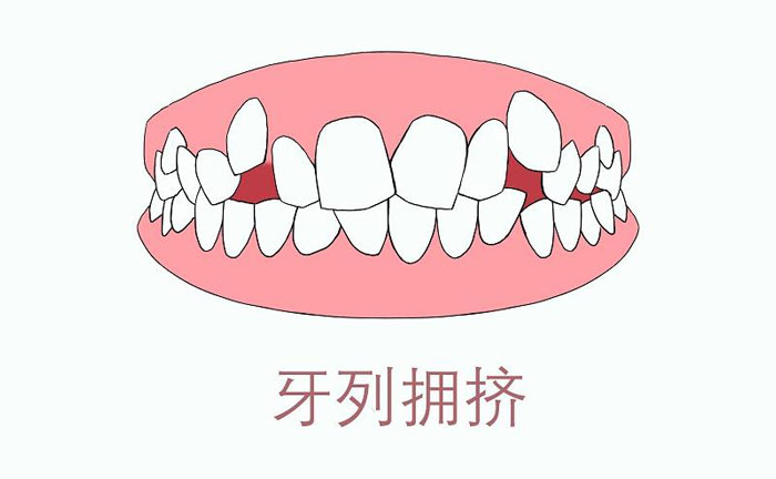 矯正牙齒擁擠度怎么算？