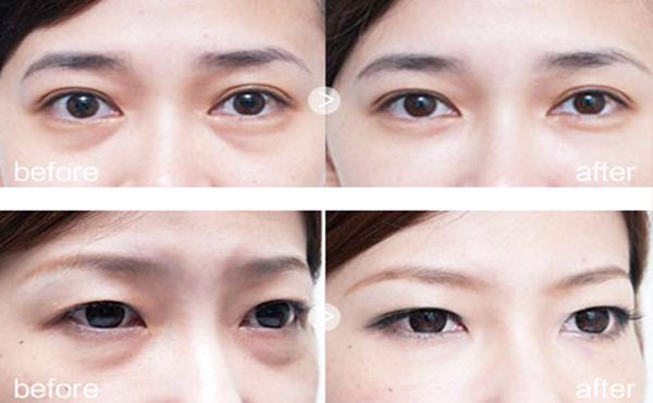 超聲去眼袋怎么做?超聲波去眼袋效果好嗎?