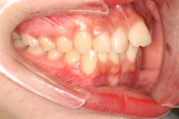 陳育松牙齒矯正案例分享：自鎖托槽案例