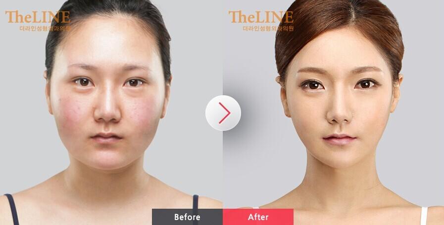 削臉頰骨需要多少錢？削臉頰骨成功率高嗎？