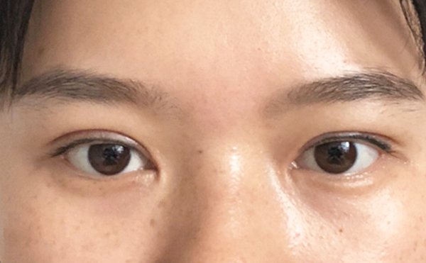 大小眼怎么改善?大小眼矯正多少錢?