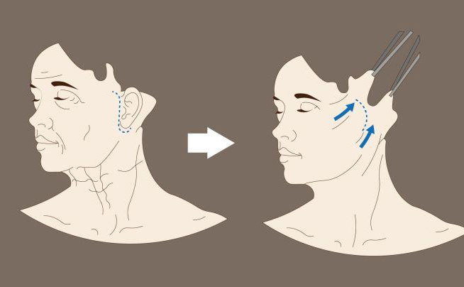 電波拉皮一次大概多少錢(qián)？