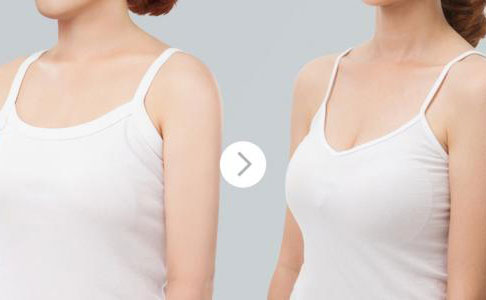 假體隆胸的費用是多少？