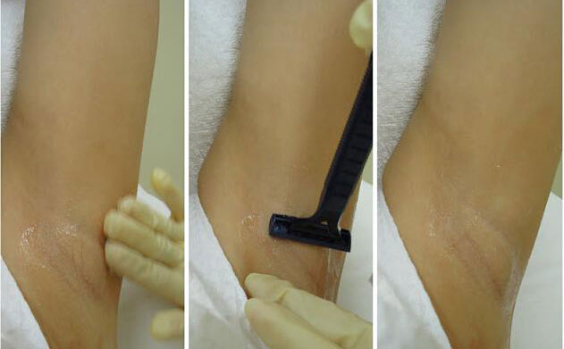 激光脫腋毛安全嗎？