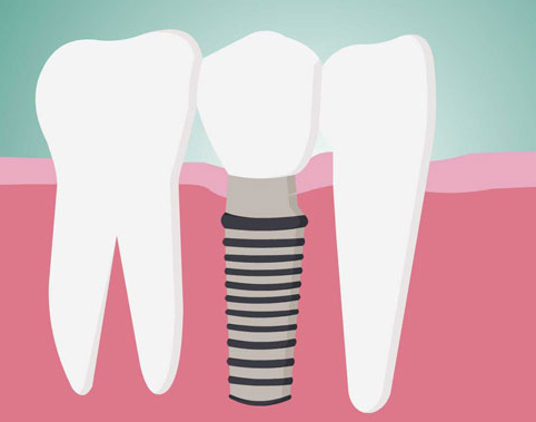 牙齒修復(fù)多少錢一顆？