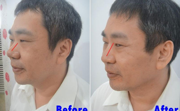 男性隆鼻子大概多少錢？