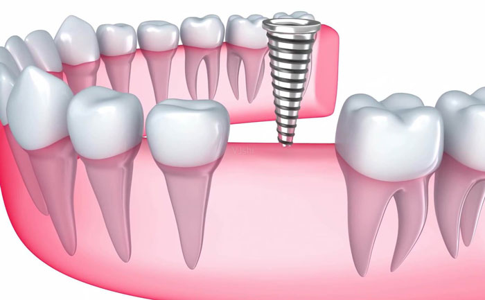 牙齒種植大概費(fèi)用是多少？牙齒種植多少錢一顆