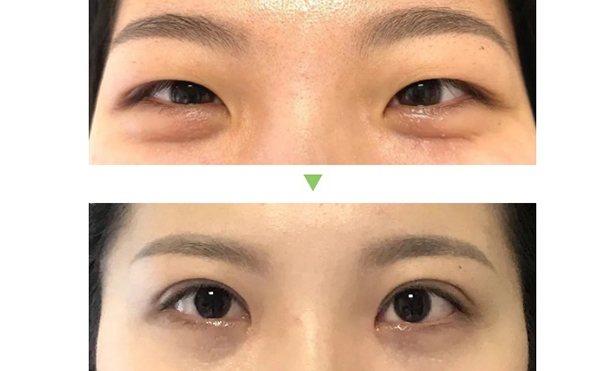 雙眼皮手術(shù)的種類及優(yōu)缺點是什么?術(shù)后怎么護理效果好?