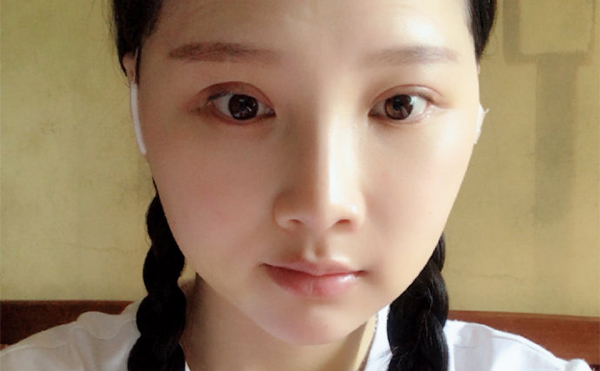 北京聯(lián)合麗格下頜角整形案例術(shù)后一周