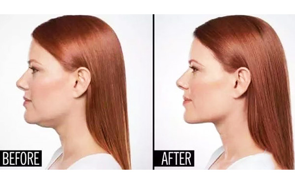 超聲波面部吸脂的過程是什么？