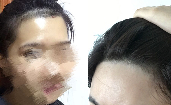 冰點(diǎn)面部脫毛有沒(méi)有疼痛感？