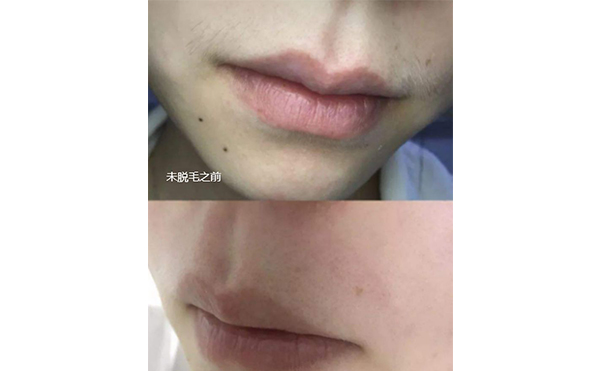 脫毛需要多久恢復(fù)?面部脫毛間隔多久做一次?