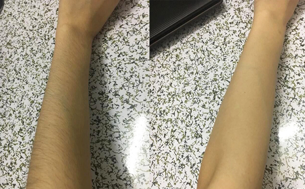 手臂脫毛