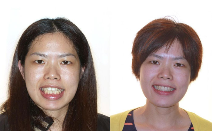 齙牙矯正可以改善凸嘴嗎？